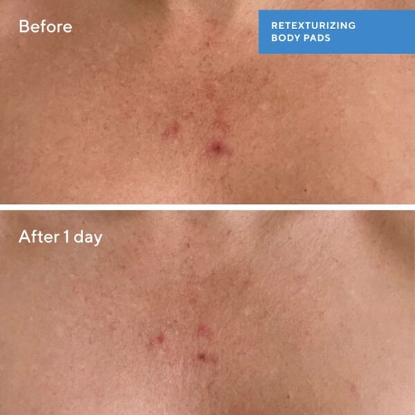 Retexturizing Body Pads with Salicylic Acid - Image 3