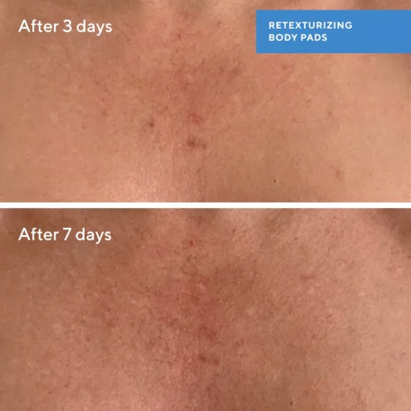 Retexturizing Body Pads with Salicylic Acid - Image 4