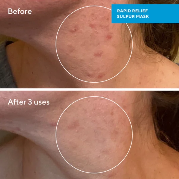 Rapid Relief Acne Sulfur Clay Mask with Salicylic Acid - Image 3