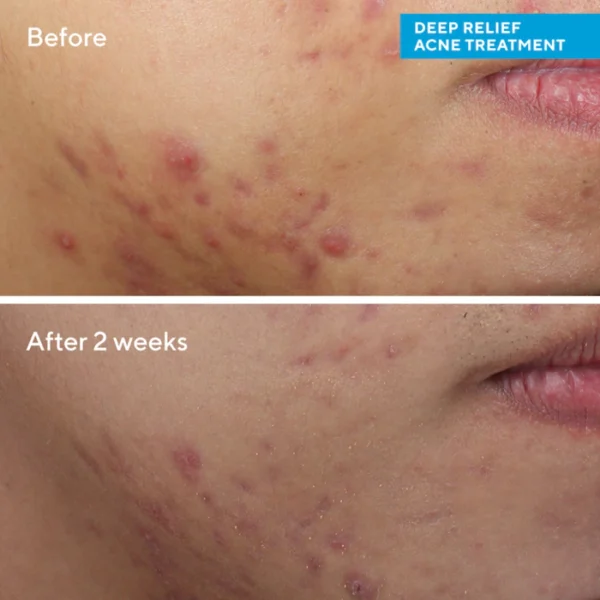 Deep Relief Blemish Treatment with Salicylic Acid - Image 4